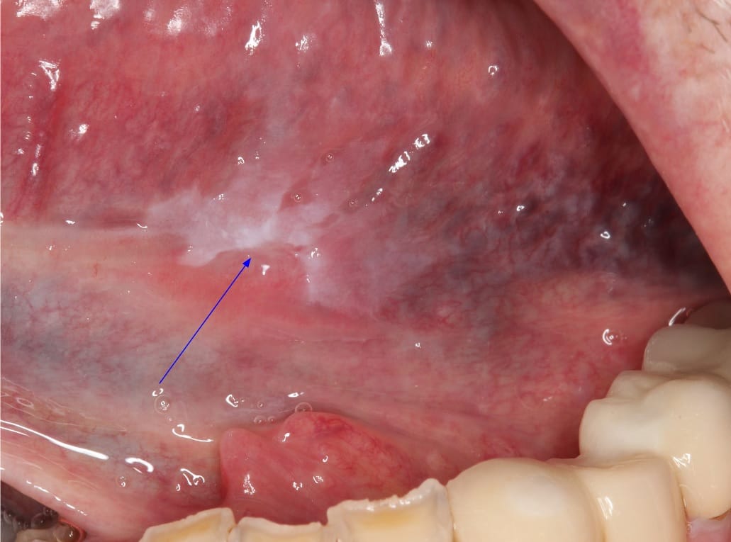 Deep Dive: Monitoring Large Leukoplakia - Weighing the Utility of Adjunctive Techniques in Clinical Practice